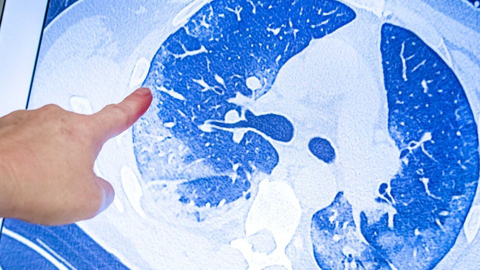 Covid-19-Spätfolgen Vier Patienten, die unter Spätfolgen leiden