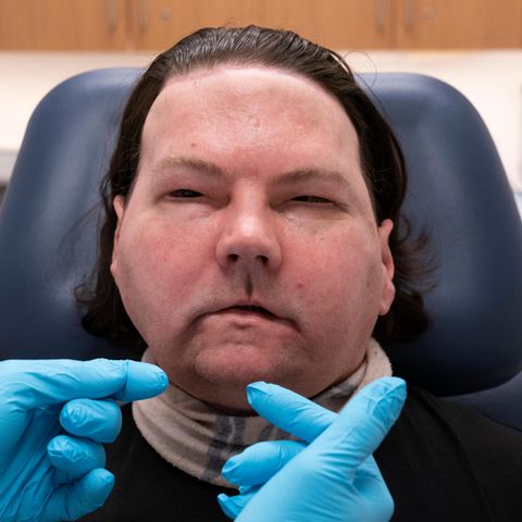 Aufnahme des Transplantierten Gesichts von Joe DiMeo