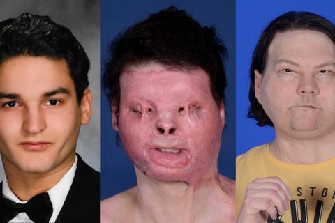 Nach schwerem Autounfall: Spektakuläre Transplantation: Mann bekommt Gesicht und Hände eines Toten
