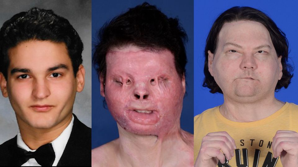 Nach schwerem Autounfall: Spektakuläre Transplantation: Mann bekommt Gesicht und Hände eines Toten
