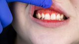 Entfernen Sie auch Beläge am Zahnfleischrand sorgfältig. Zahnfleischbluten sollten Sie als ernstes Signal einer Entzündung wahrnehmen. Unbehandelte Zahnfleischentzündungen können zu einer Parodontitis führen.