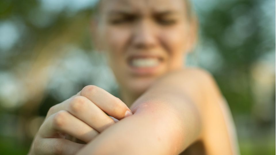 Eine Frau kratzt sich nach dem Stich einer Mücke