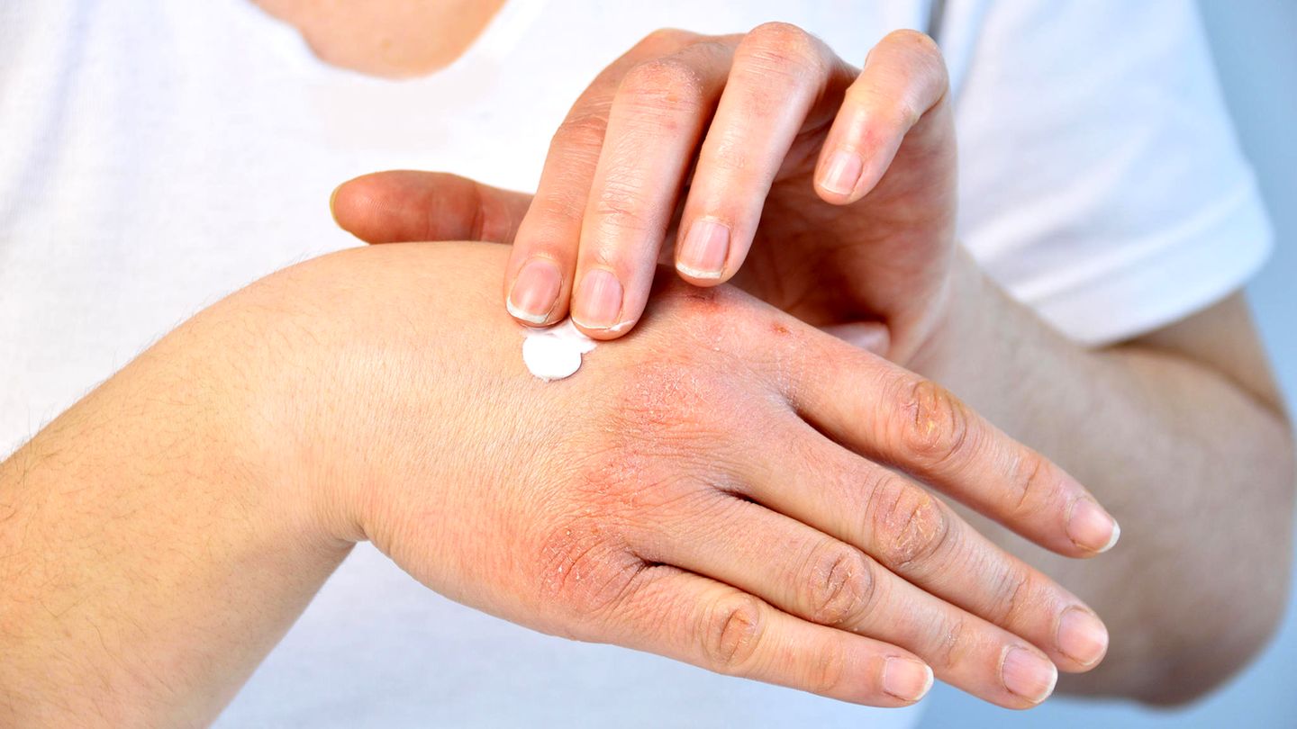 Hauterkrankung: Unsere Autorin leidet an Neurodermitis. Bislang hilft wenig. Jetzt machen neue Therapien Hoffnung Hauterkrankung: Unsere Autorin leidet an Neurodermitis. Bislang hilft wenig. Jetzt machen neue Therapien Hoffnung