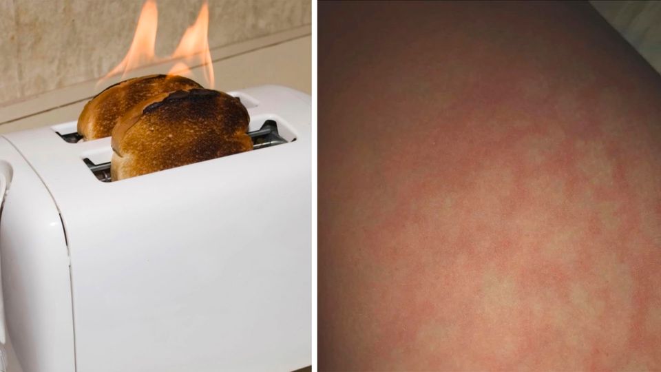 Wenn das Home-Office gefährlich wird – Toasted Skin Syndrom