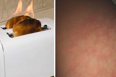 Wenn das Home-Office gefährlich wird – Toasted Skin Syndrom