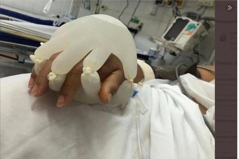 Brasilien: Berührungen für Covid-19-Patienten: Krankenpfleger füllt Gummihandschuhe mit Wasser