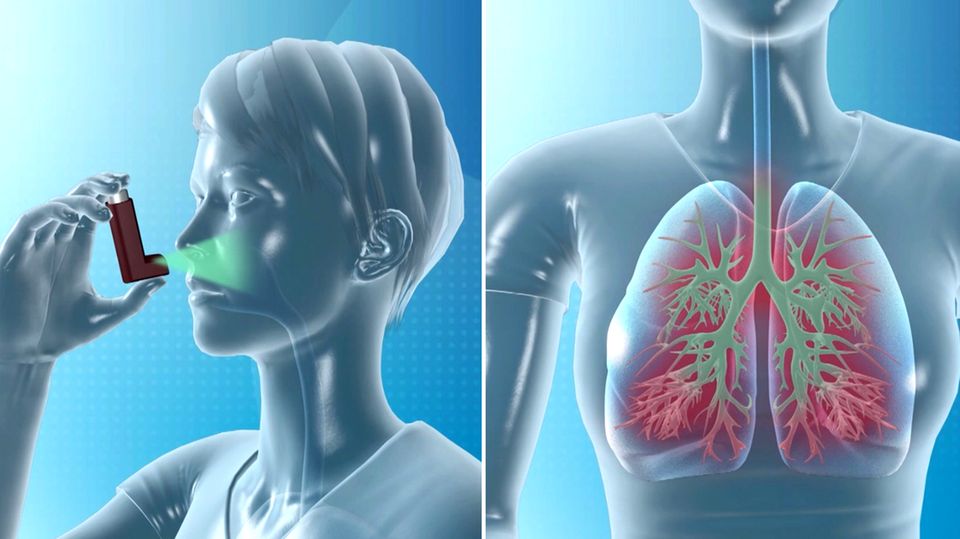 Asthmamittel Animation