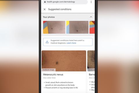 "Derm Assist": Google will mit KI Hautkrankheiten erkennen