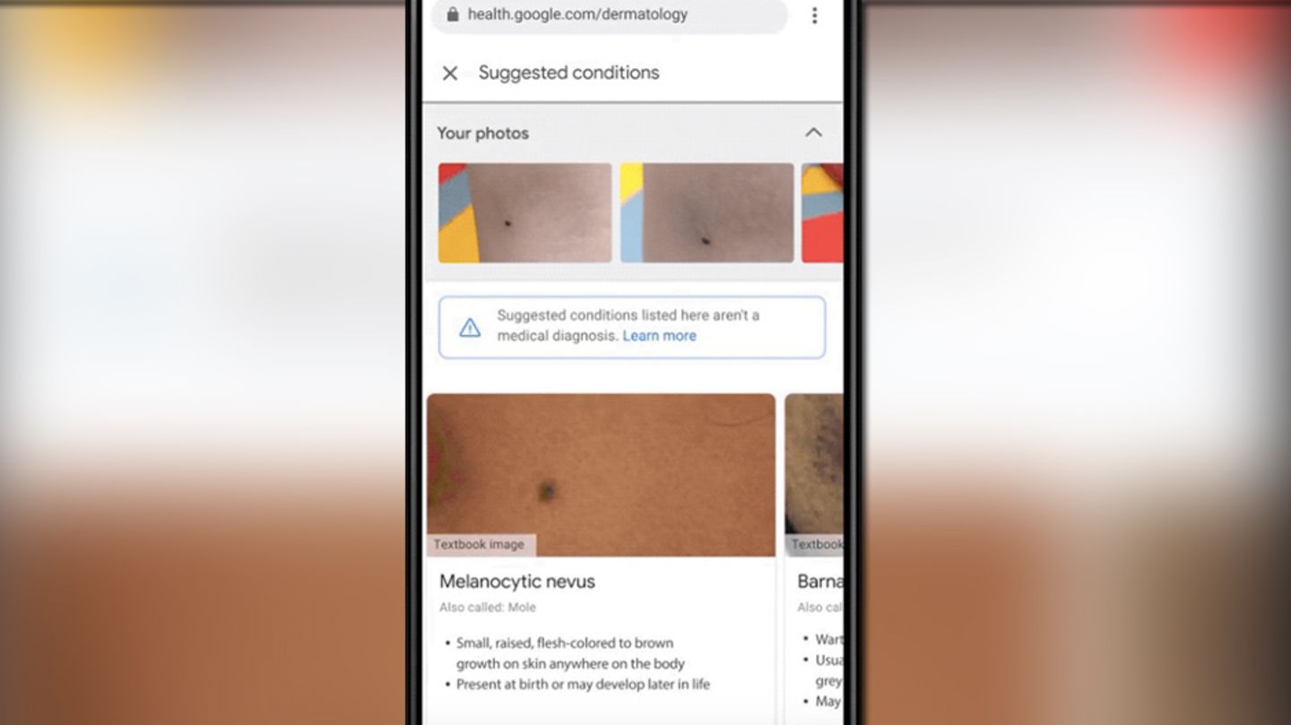 "Derm Assist": Google will mit KI Hautkrankheiten erkennen