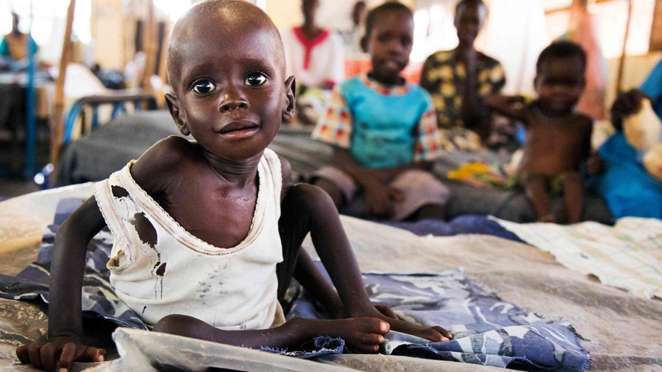 Hunger Klimawandel Ein Kind in Afrika leidet an schwerer Unterernährung