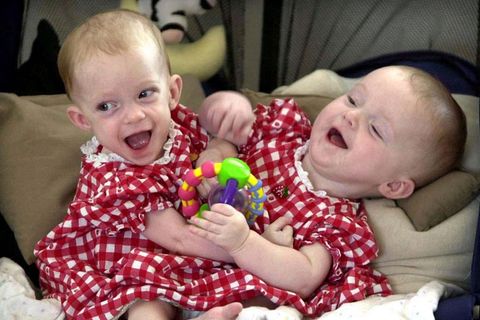 USA: Siamesische Schwester bekommt ihr Baby genau dort, wo sie vom Zwilling getrennt wurde.