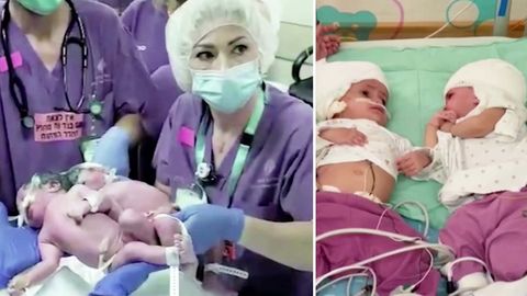 Brasilien : Am Kopf verbundene siamesische Zwillinge in mehreren Operationen voneinander getrennt
