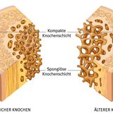 Beim Orthopäden oder Radiologen: Knochendichtemessung  Bei der Dual-Röntgen-Absorptiometrie (DXA) wird mit einem speziellen Röntgengerät die Knochendichte an Lendenwirbelsäule und Oberschenkel ermittelt.  Für wen angeboten?  Für ältere Erwachsene, besonders für Frauen nach den Wechseljahren.  Kosten: Circa 40 bis 60 Euro; kostenlos, wenn bereits ein Bruch vorliegt oder begründeter Verdacht auf Osteoporose besteht.  Bewertung: Nach einer Knochendichtemessung mittels DXA und anschließender Therapie traten bei Probanden weniger Knochenbrüche auf. Möglicherweise sinnvoll für Frauen ab 70 und Männer ab 80 Jahren. Liegen Hinweise auf ein Osteoporoserisiko vor (etwa Bruch eines Wirbelkörpers, längere Einnahme von Cortison) auch schon für Frauen um die 60 Jahre.  Was folgt, wenn der Arzt etwas findet?  Eventuell weitere Röntgenaufnahmen zur Abklärung.
