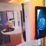 Röntgenuntersuchung der Brust (Mammografie) 