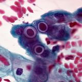 Chlamydien-Test  In einer Urinprobe wird das Erbgut des Bakteriums Chlamydia trachomatis nachgewiesen. Der Keim kann Unterleibsentzündungen und Schwangerschaftskomplikationen auslösen.  Für wen angeboten?  Für junge Frauen und Schwangere sowie vor einem Schwangerschaftsabbruch.  Kosten: Für Frauen bis 25 Jahre jedes Jahr und zu Beginn einer Schwangerschaft oder vor einem Schwangerschaftsabbruch einmalig kostenlos.  Bewertung Der Test ist sinnvoll für junge und sexuell aktive Frauen, für Schwangere und vor einem Schwangerschaftsabbruch, weil er das Risiko für Entzündungen und Unfruchtbarkeit vermindert. Er liefert keinen Hinweis, seit wann und von wem man die Infektion hat. Diskutiert wird, ob der Test auch für Männer zu empfehlen ist.  Was folgt, wenn der Arzt etwas findet?   Einnahme von Antibiotika (Partner mitbehandeln!), für einige Zeit Benutzung von Kondomen beim Geschlechtsverkehr.