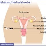 Früherkennung von Gebärmutterhalskrebs (Pap-Abstrich)