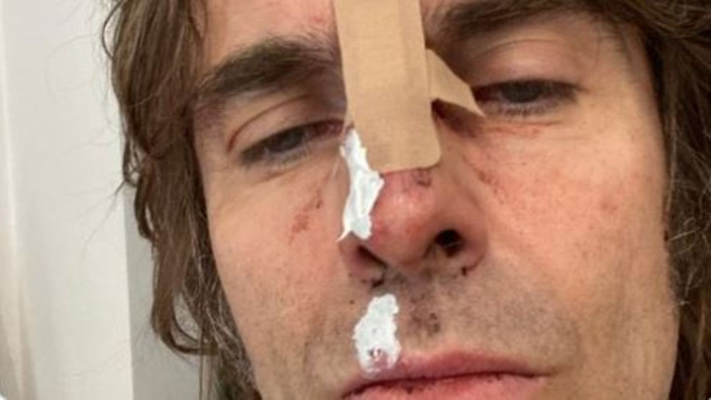 Liam Gallagher falls from the helicopter and shows himself with a scarred face