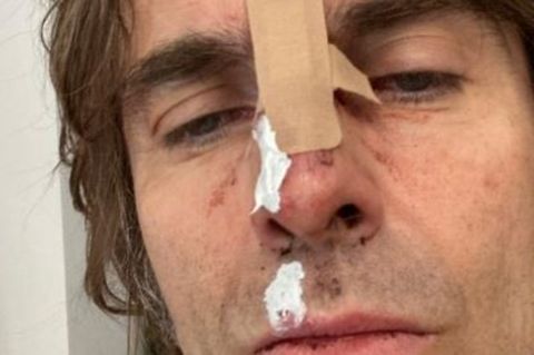 Liam Gallagher postet Selfie nach Sturz aus Helikopter
