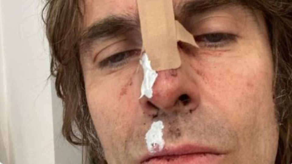 Liam Gallagher postet Selfie nach Sturz aus Helikopter
