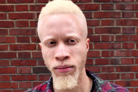 Albino: 15 Mitglieder einer britischen Familie haben Albinismus
