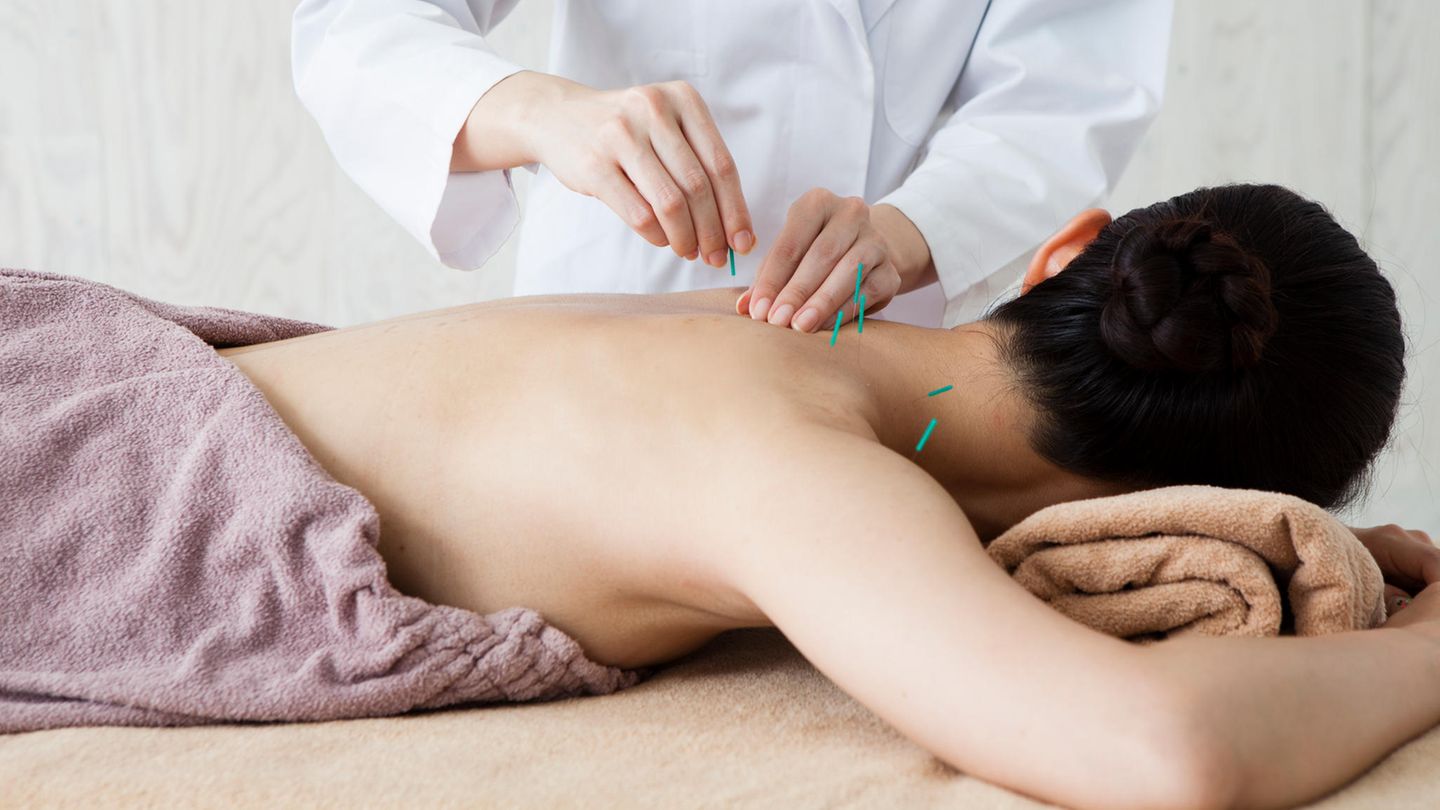 Akupunktur