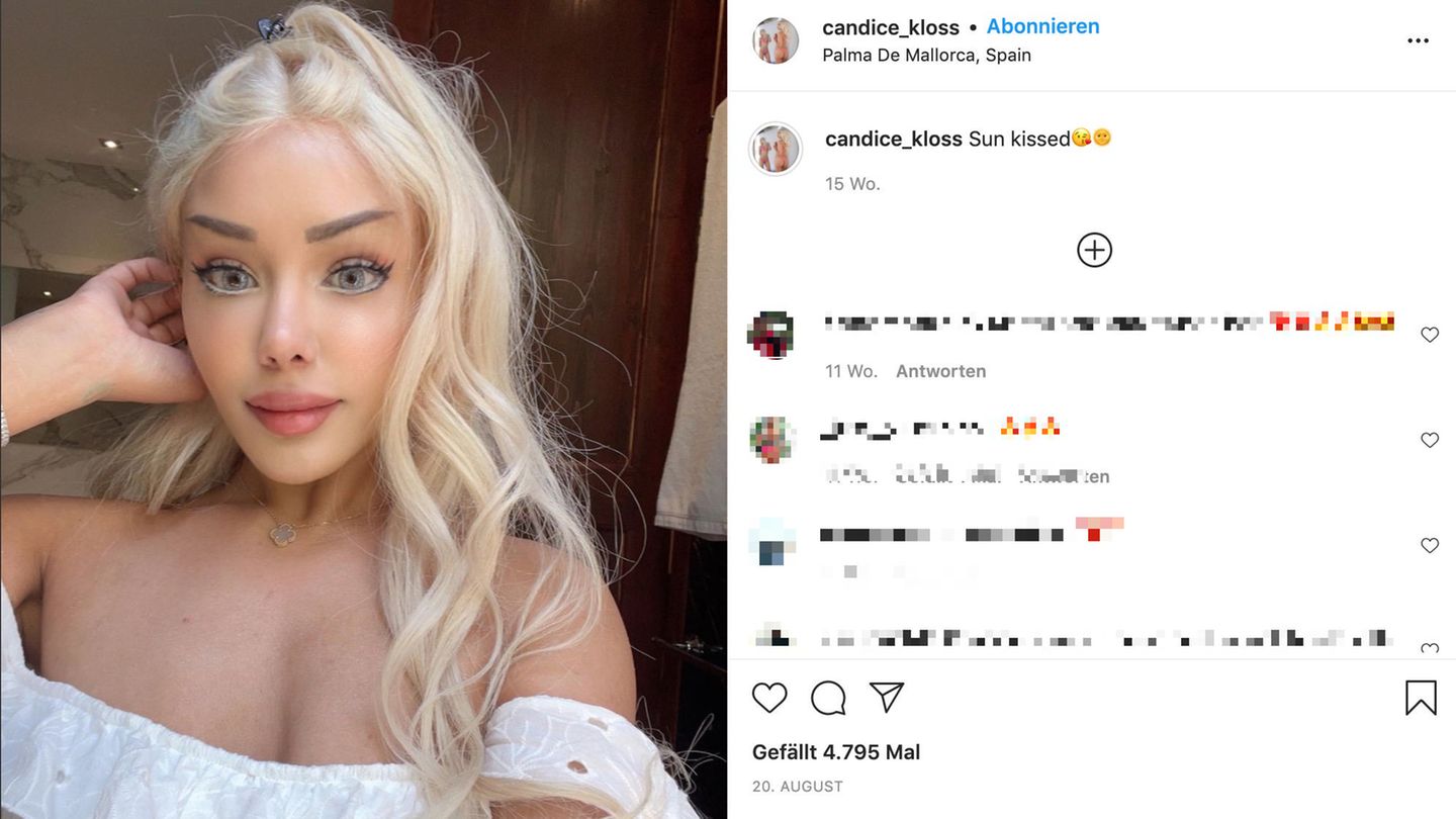 Candice Kloss hat sich mittlerweile einen Teil ihrer Filler auflösen lassen
