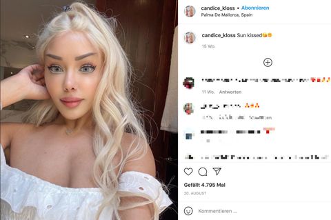 Candice Kloss hat sich mittlerweile einen Teil ihrer Filler auflösen lassen