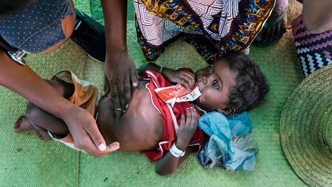Helfer von Ärzte ohne Grenzen untersuchen ein unterernährtes Mädchen. Das von Hunger geplagte Kind nuckelt an einer Tüte mit der Proteinpaste "Plumpy Nut", die ihm helfen soll, rasch zu Kräften zu kommen