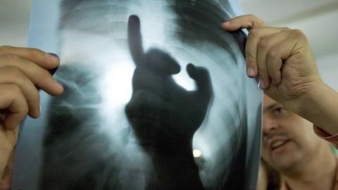 Ärzte betrachten die Röntgenaufnahme eines Tuberkulose-Patienten