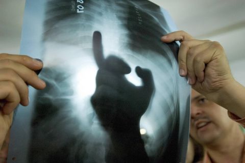 Ärzte betrachten die Röntgenaufnahme eines Tuberkulose-Patienten