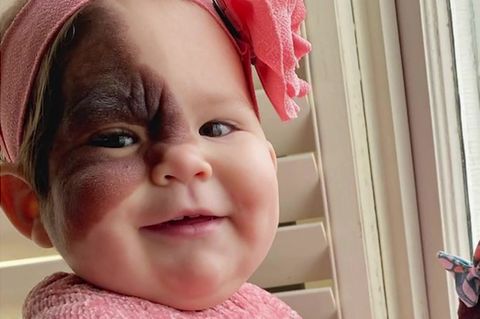 Baby mit einem Muttermal hält eine Puppe mit Muttermal im Gesicht in der Hand