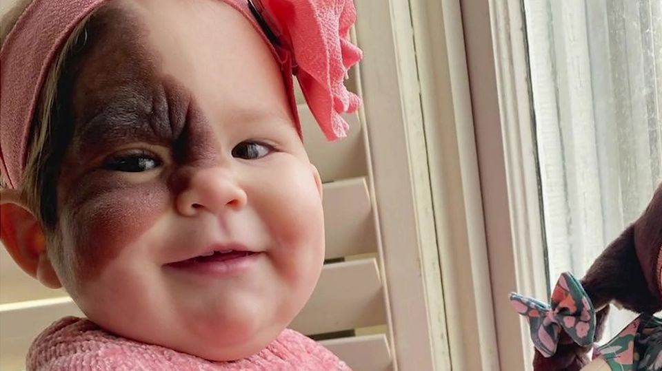 Muttermal im Gesicht: Mutter teilt Videos ihrer Tochter – um sie vor Mobbing zu schützen Baby mit einem Muttermal hält eine Puppe mit Muttermal im Gesicht in der Hand
