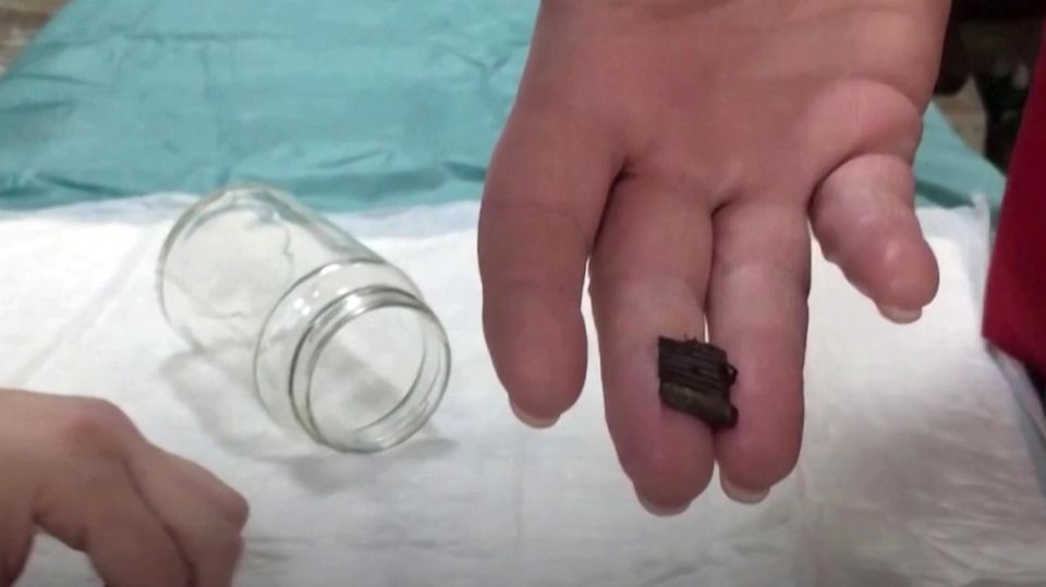 Ukraine-Krieg: Magnete ziehen in Krankenhaus Metall aus Wunden