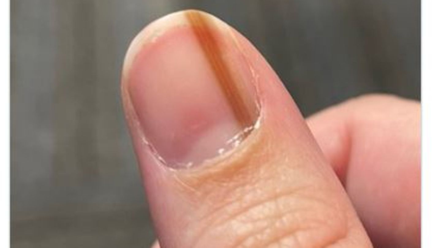 Subunguales Melanom: Muttermal bei Frau entpuppt sich als Krebs | STERN.de