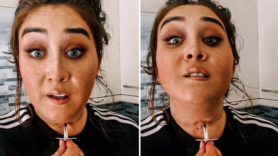 Video geht viral: Junge Frau zeigt, wie die ihre Atemkanüle wechselt Video geht viral: Junge Frau zeigt, wie die ihre Atemkanüle wechselt