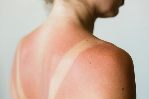 Frau hat Sonnenbrand auf den Schultern