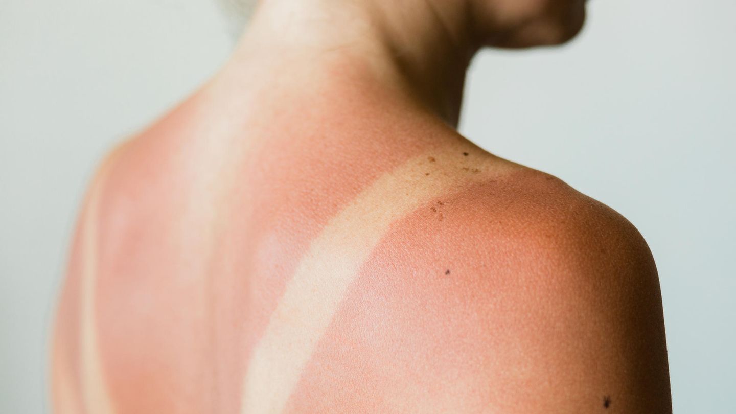 Frau hat Sonnenbrand auf den Schultern