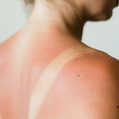 Frau hat Sonnenbrand auf den Schultern