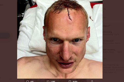 Ein Zeichen des Sieges: Sebastian Rode zeigt nach dem Finale auf Twitter die frisch genähte Platzwunde