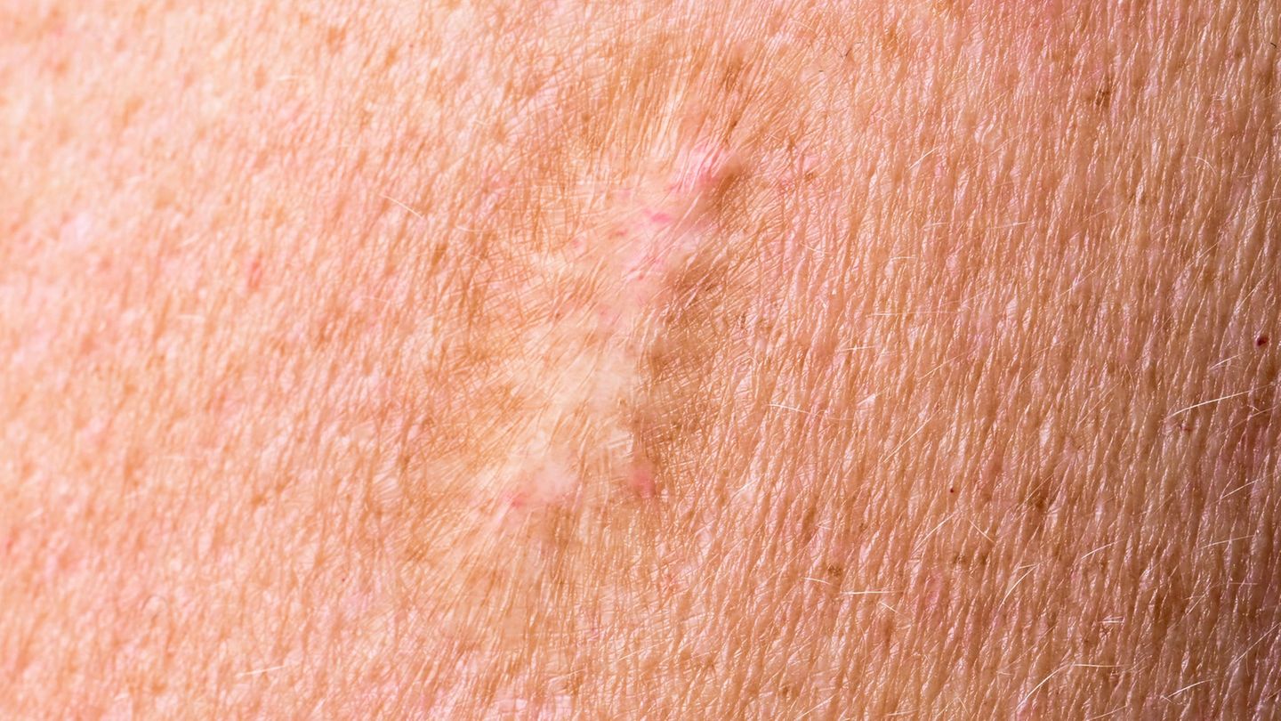 Pockennarbe am Oberarm durch die Impfung