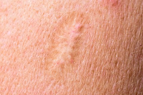 Pockennarbe am Oberarm durch die Impfung