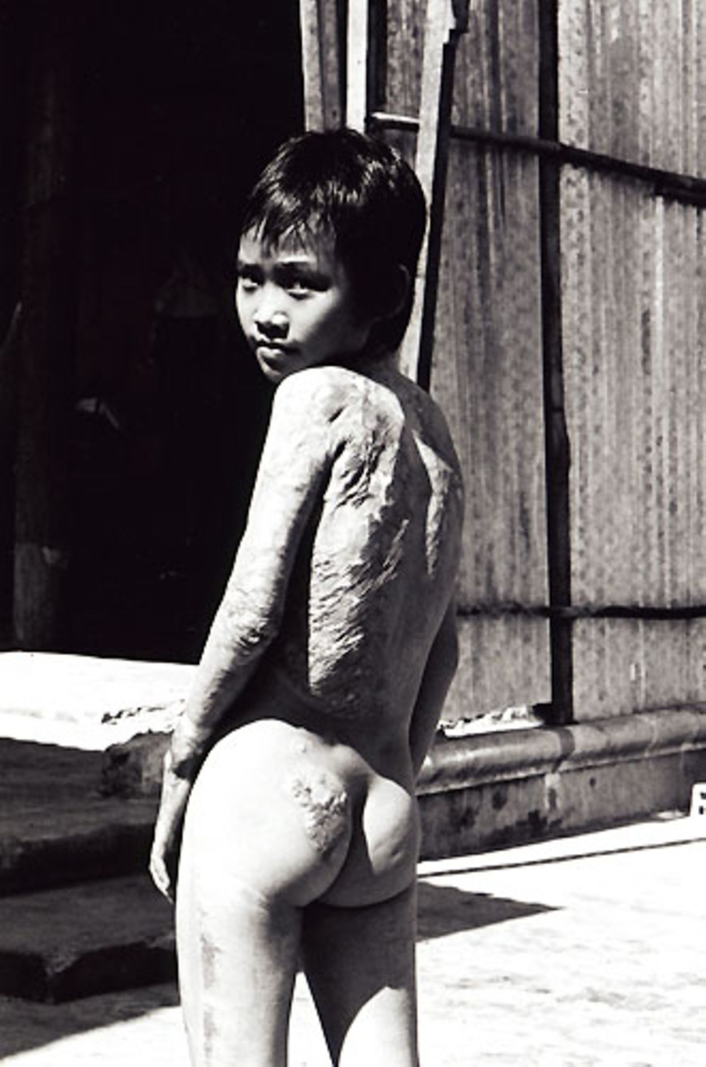 Kim Phuc hatte zu diesem Zeitpunkt bereits zahlreiche Operationen hinter sich, ihr wurde gesunde Haut von den Beinen auf die verbrannten Rücken- und Armpartien verpflanzt. Sie litt unter furchtbaren Schmerzen und konnte sich kaum bewegen, weil die verpflanzte Haut zu sehr spannte.