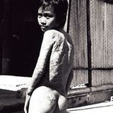 Kim Phuc hatte zu diesem Zeitpunkt bereits zahlreiche Operationen hinter sich, ihr wurde gesunde Haut von den Beinen auf die verbrannten Rücken- und Armpartien verpflanzt. Sie litt unter furchtbaren Schmerzen und konnte sich kaum bewegen, weil die verpflanzte Haut zu sehr spannte.