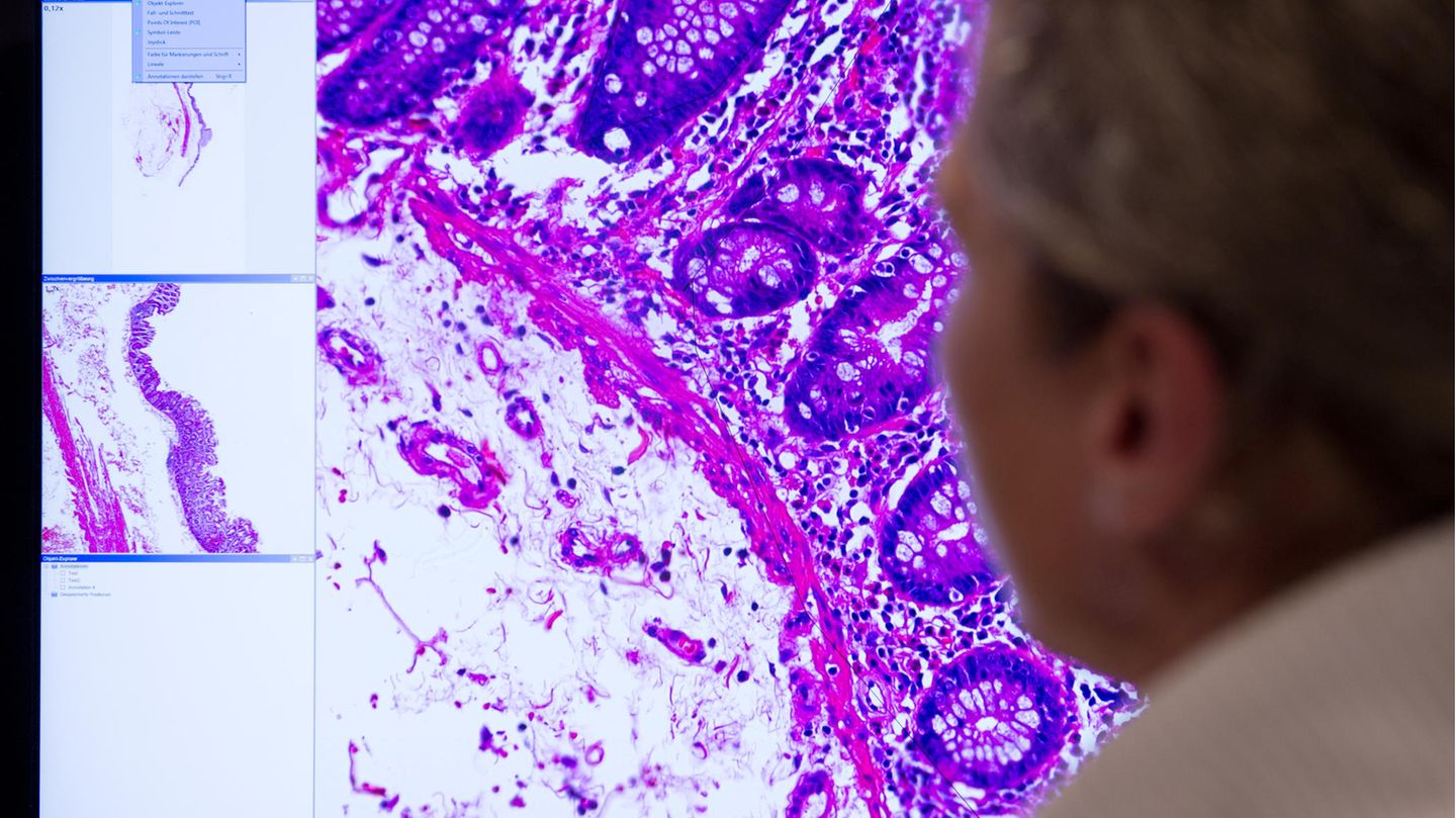 Bild eines Darmkrebses im Gewebe