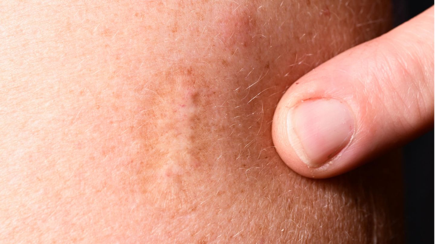 Wer bereits gegen Pocken geimpft wurde, hat meist eine Narbe am Oberarm.