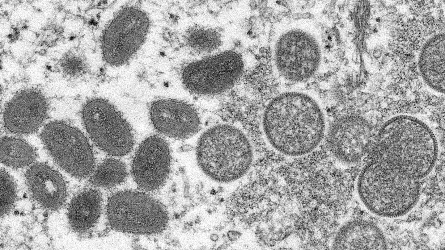 Affenpocken-Viren unter einem Mikroskop