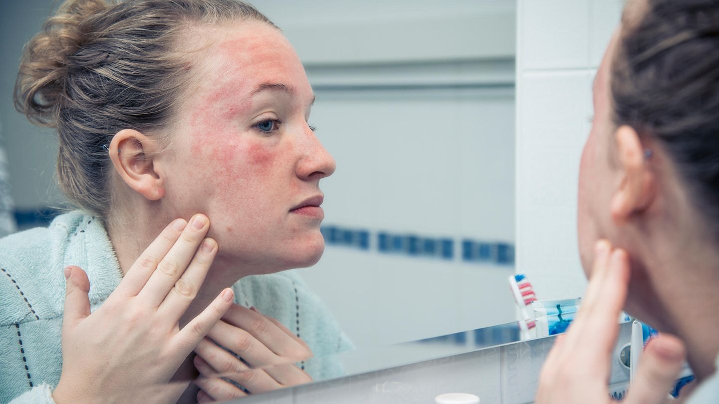 Salben mit Harnstoff  Die Hautbarriere von Neurodermitikern ist gestört. Aufgrund einer nicht optimalen Fettzusammensetzung der Haut geht Feuchtigkeit verloren. Cremes und Salben mit fünf- bis zehnprozentigem Harnstoff (Urea) erhalten die Haut weich und geschmeidig, der Harnstoff bindet Feuchtigkeit in der Haut. Allerdings gehören harnstoffhaltige Pflegemittel nicht auf stark entzündete oder verletzte Ekzemhaut.  Salben mit Gerbstoffen  Bei einer leichten Neurodermitis können gerbstoffhaltige Mittel ausreichen. Sie wirken leicht entzündungshemmend und stillen den Juckreiz. Die nässenden Ekzemstellen trocknen aus. So lässt sich verhindern, dass Bakterien oder Pilze die Stellen infizieren.  Örtlich betäubende Salben  Die örtlich betäubende Substanz Polidocanol verringert die Empfindlichkeit der Nervenenden. Dadurch sind auch Schmerzen und Juckreiz bei einer Neurodermitis weniger stark spürbar.