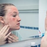 Salben mit Harnstoff  Die Hautbarriere von Neurodermitikern ist gestört. Aufgrund einer nicht optimalen Fettzusammensetzung der Haut geht Feuchtigkeit verloren. Cremes und Salben mit fünf- bis zehnprozentigem Harnstoff (Urea) erhalten die Haut weich und geschmeidig, der Harnstoff bindet Feuchtigkeit in der Haut. Allerdings gehören harnstoffhaltige Pflegemittel nicht auf stark entzündete oder verletzte Ekzemhaut.  Salben mit Gerbstoffen  Bei einer leichten Neurodermitis können gerbstoffhaltige Mittel ausreichen. Sie wirken leicht entzündungshemmend und stillen den Juckreiz. Die nässenden Ekzemstellen trocknen aus. So lässt sich verhindern, dass Bakterien oder Pilze die Stellen infizieren.  Örtlich betäubende Salben  Die örtlich betäubende Substanz Polidocanol verringert die Empfindlichkeit der Nervenenden. Dadurch sind auch Schmerzen und Juckreiz bei einer Neurodermitis weniger stark spürbar.