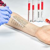 Hyposensibilisierung