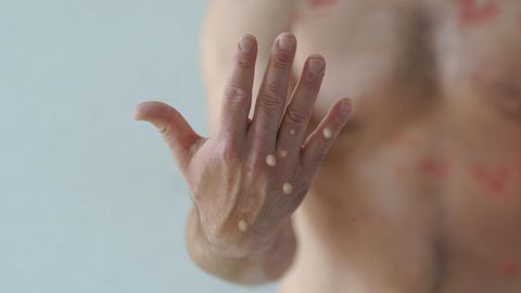 Ein Mann zeigt seine Hände mit einer möglichen Affenpockeninfektion